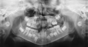 Dental Radiographs (X-Rays) - Pediatric Dentist in Portage, MI