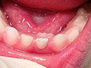 Baby Teeth - Pediatric Dentist in Portage, MI
