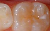 Sealant-Before - Pediatric Dentist in Portage, MI