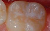Sealant-After - Pediatric Dentist in Portage, MI